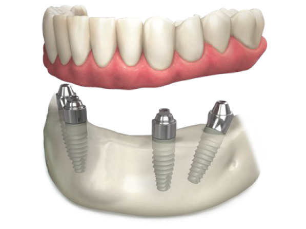 Full-Mouth-Dental-Implants